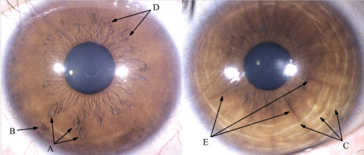 Iridology 3.4: Visceral Organ Reflex Rings