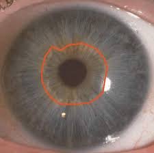 Autonomic Nerve Ring in Iridology