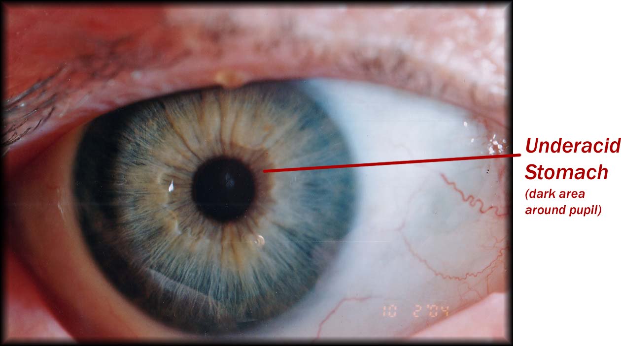 Chapter 3.1: The Stomach Ring in Iridology