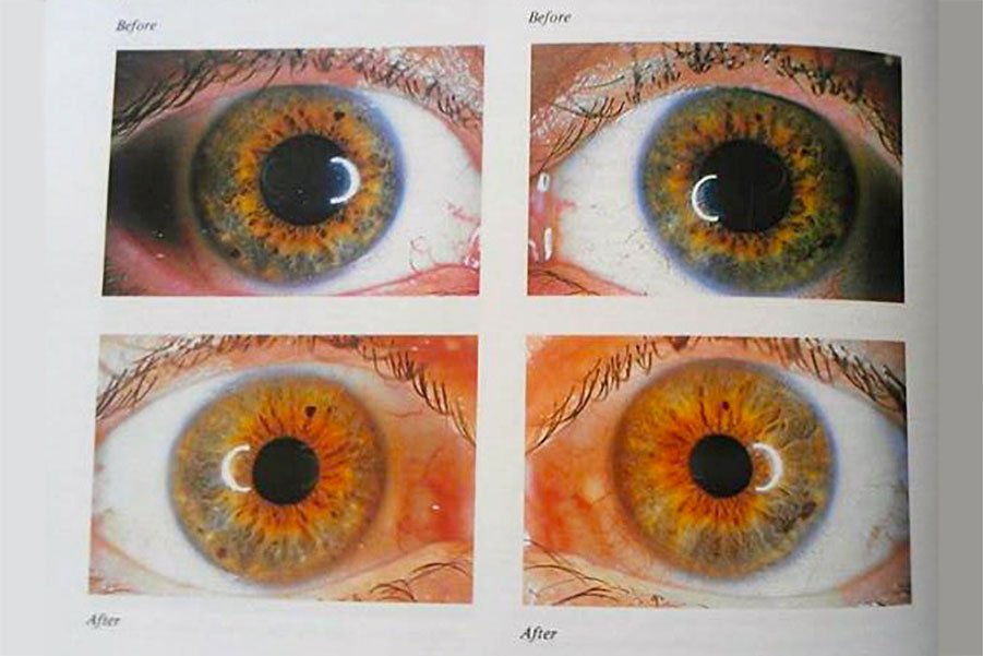 Diagnosis of Disease Based on the Iris of the Eye 1785