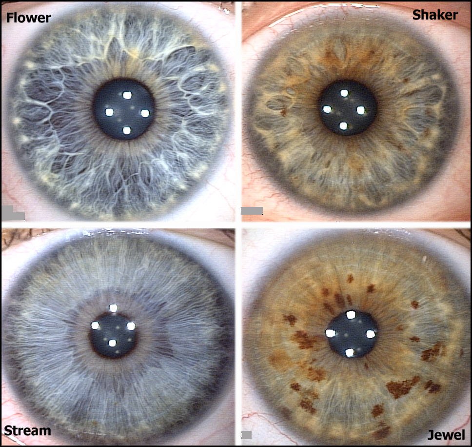 Diagnosis of Disease Based on the Iris of the Eye 1796