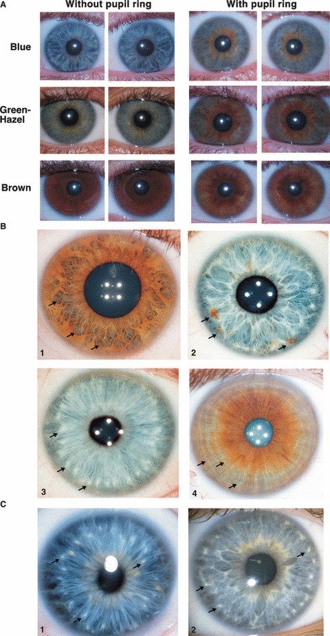 Diagnosis of Disease Based on the Iris of the Eye 1798
