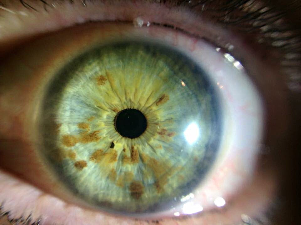 Iridology iris Pigment Spots