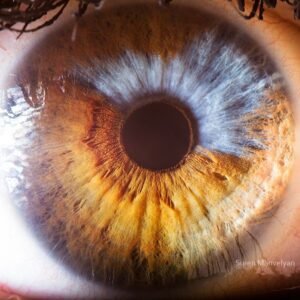 Iridology iris Pigment Spots