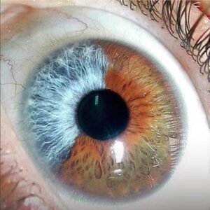 Iridology iris Pigment Spots