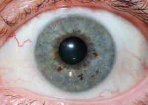 Iridology iris Pigment Spots