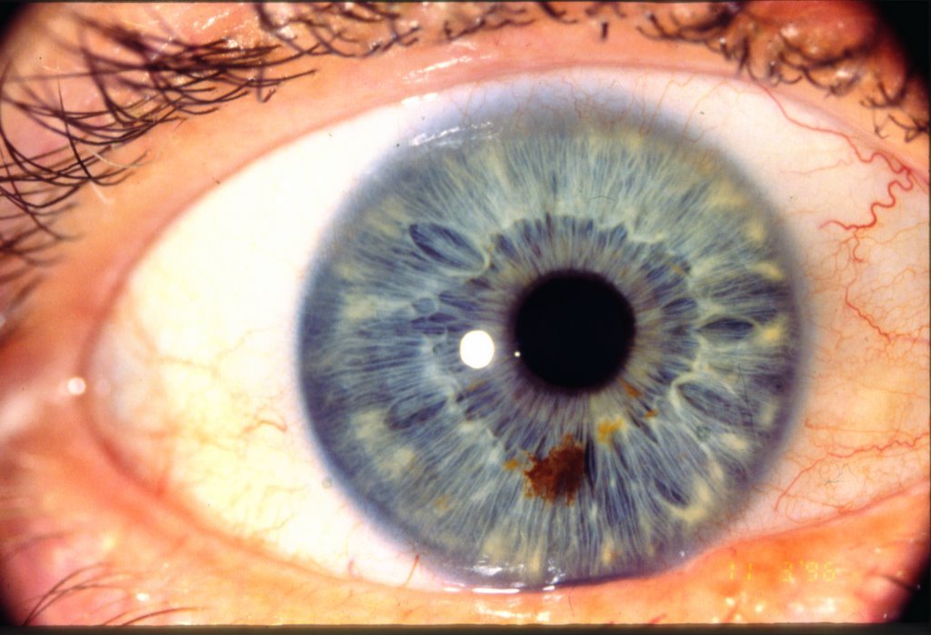 The Role of Iridology in Health Management