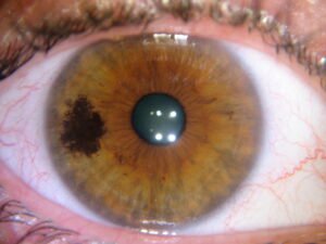 Iridology iris Pigment Spots