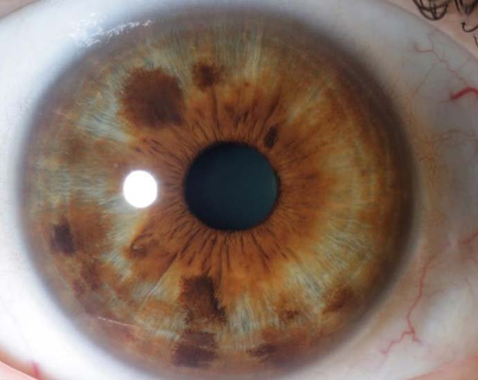 Iridology 7.3: The Relationship Between Pigment Spots and Organ Function