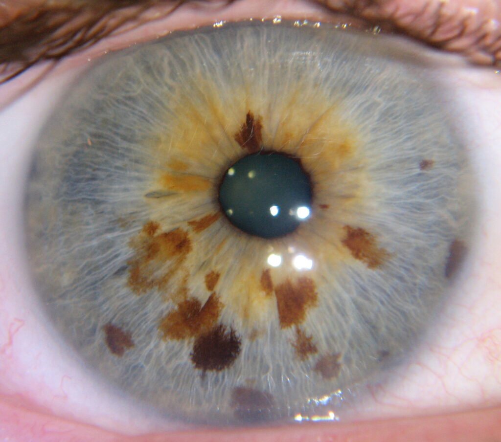 What is Herbal Iridology?