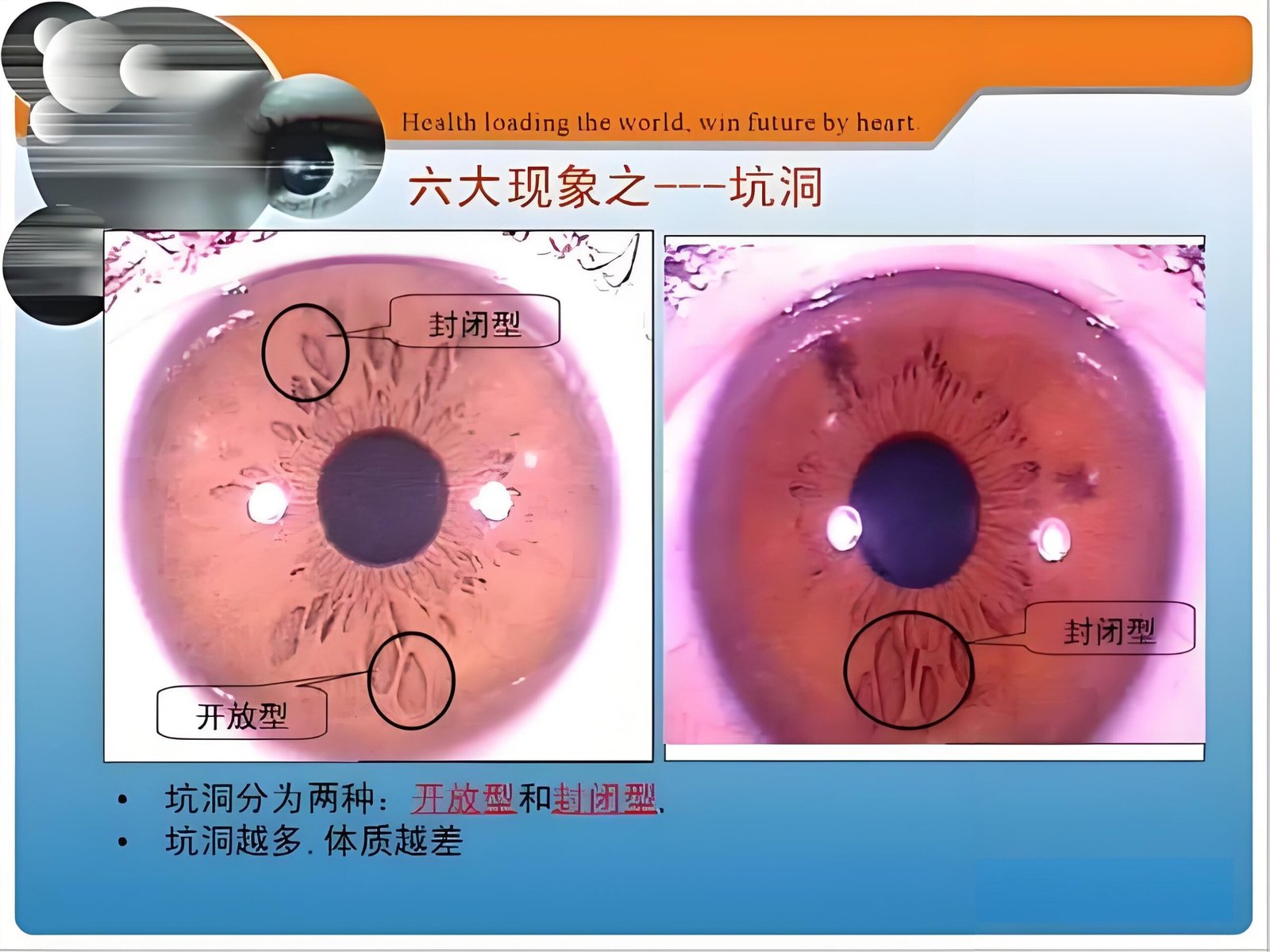 Iridology Between Pit iris 1 scaled