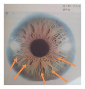 Iridology Between Pit iris 2