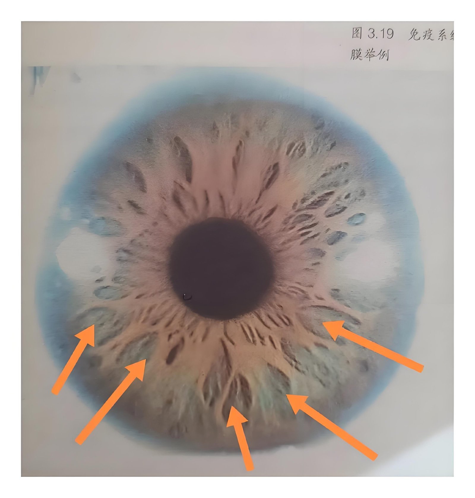 Iridology Between Pit iris 2 scaled