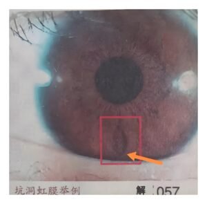 Iridology Between Pit iris 3 1