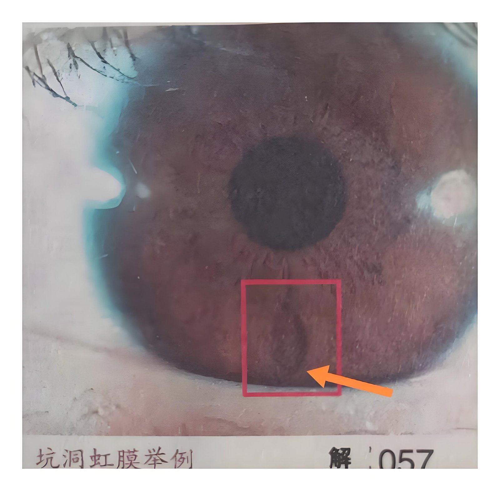 Iridology Between Pit iris 3 scaled