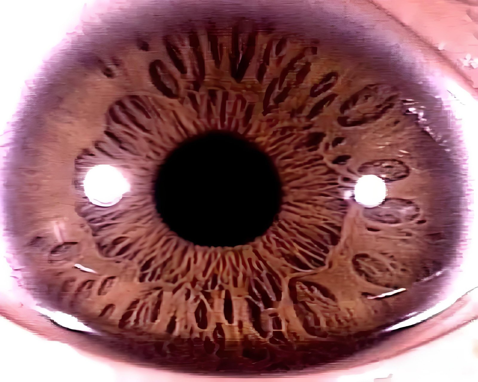 Iridology 7.1: Relationship Between Pits on Iris and Genetics