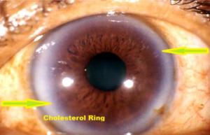 Iridology Iris sodium ring 1