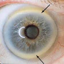 Iridology Iris sodium ring 2