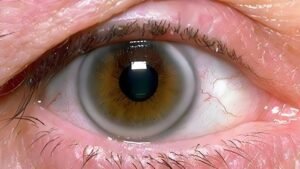 Iridology Iris sodium ring 3