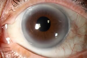Iridology Iris sodium ring 4