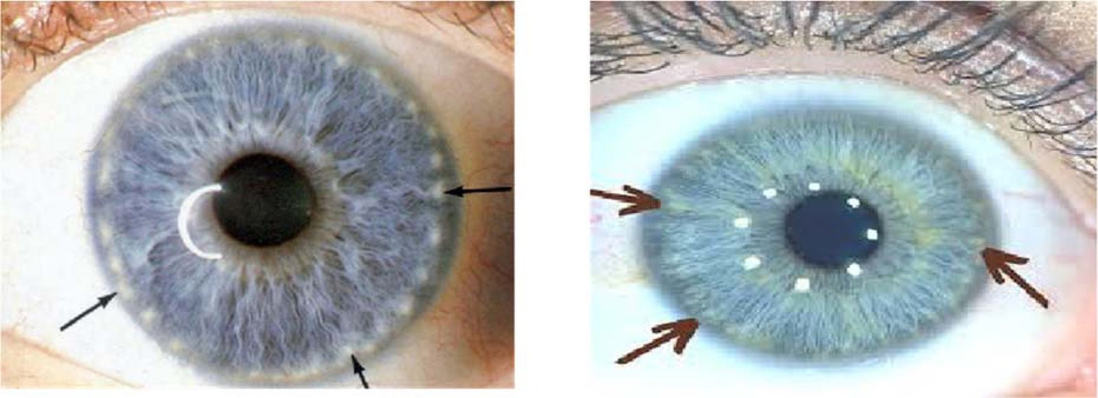Iridology 3.5: Lymphatic System Ring