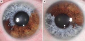 Iridology iris Pigment Spots