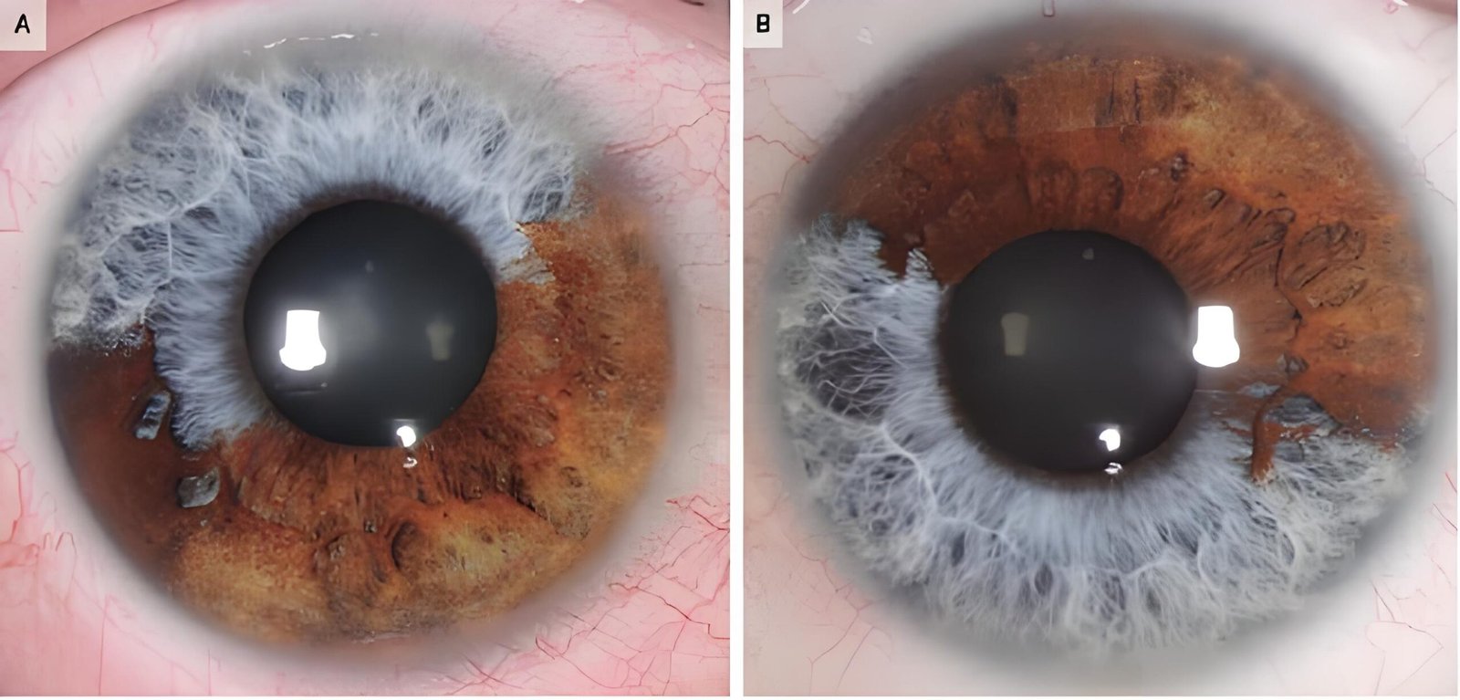 Iridology iris Pigment Spots