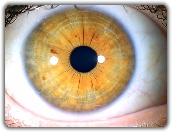 What is Iridology?