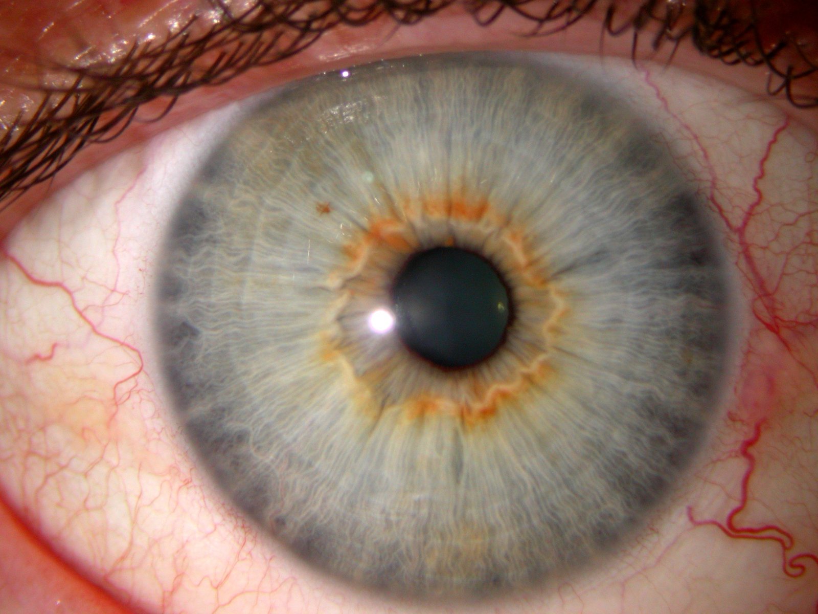 Chapter 3.2: The Intestinal Ring in Iridology
