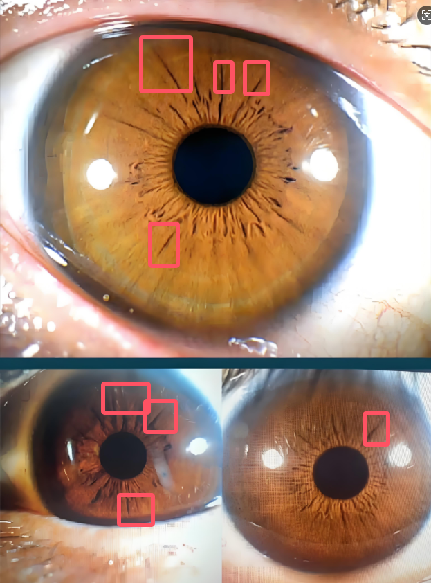 Iridology 7.2: The Relationship Between Cracks on the Iris and the Body