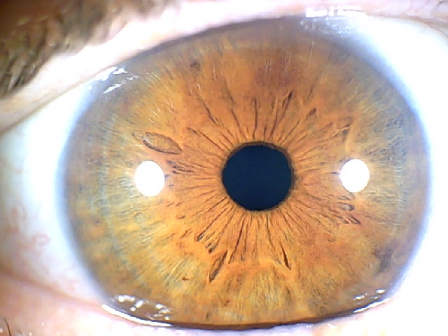iridology​ Eye 1