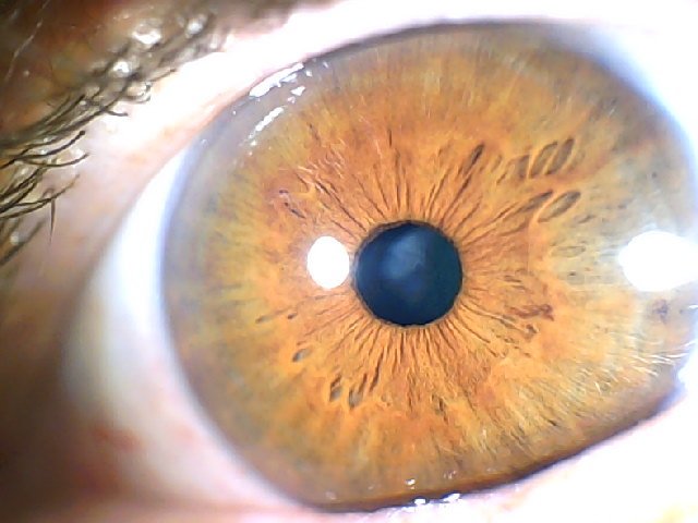 iridology​ Eye 5 1