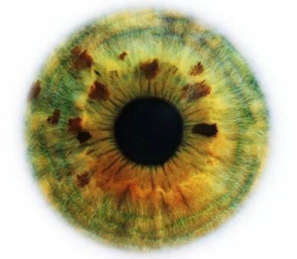 Iridology near me: a practical sourcing and reseller checklist for Australian health‑tech resellers — red ring around iris (1).jpg