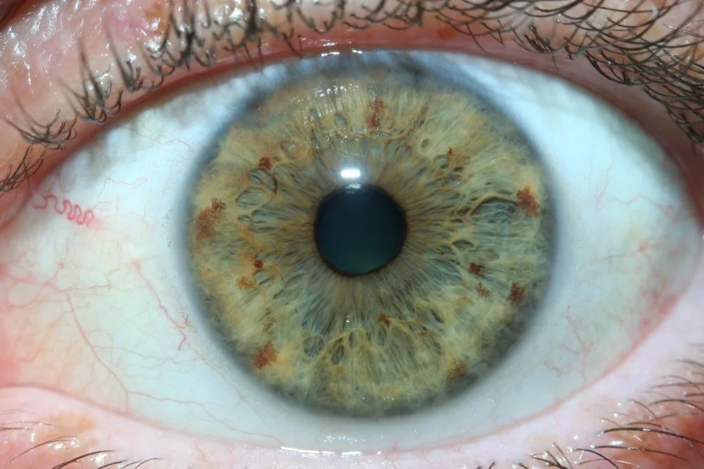 Which iridology camera should my Australian clinic or training school choose — what to compare and why 2 Which iridology camera should my Australian clinic or training school choose — what to compare and why — iridology images 15.jpg