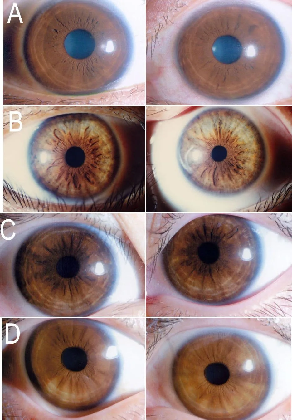 Which iriscope should Australian professional iridologists choose? A practical recommendation — MAIKONG iridology eye color (4).jpg