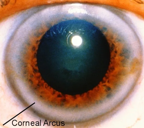 Before you buy: how to compare iridology equipment on the same dimensions, evidence and suitability for Australia — red ring around iris (1).png